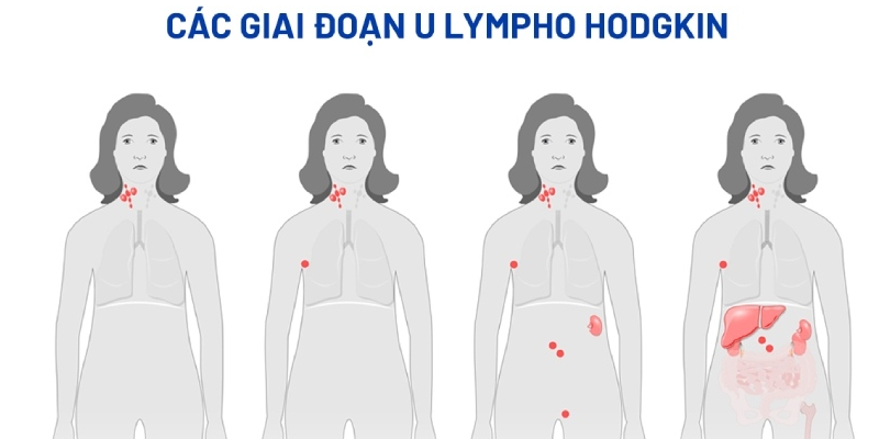 Các giai đoạn bệnh u lympho hodgkin