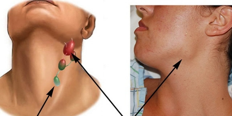 Xuất hiện hạch lớn không đau là dấu hiệu nhận biết u lympho Hodgkin ở trẻ