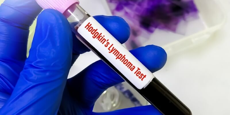 Xét nghiệm máu bệnh học u lympho không hodgkin giúp chẩn đoán sớm nguy cơ