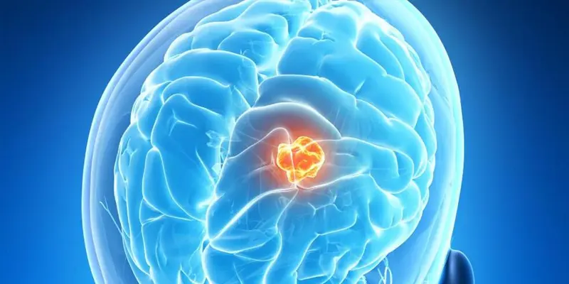 Bệnh u não là một loại u trong não