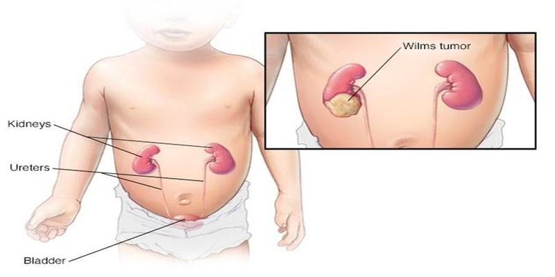 U nguyên bào thận thường liên quan đến các đột biến ở gen WT1, gen CTNNB1 hoặc gen AMER1