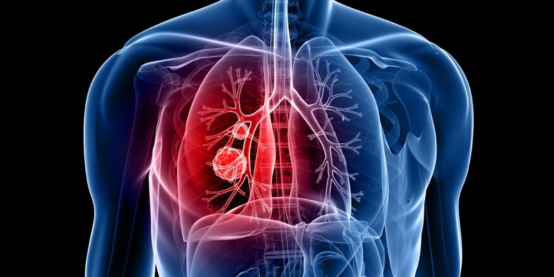 U phổi lành tính là khối u hình thành ở phổi, không lây lan di căn đến các bộ phận khác