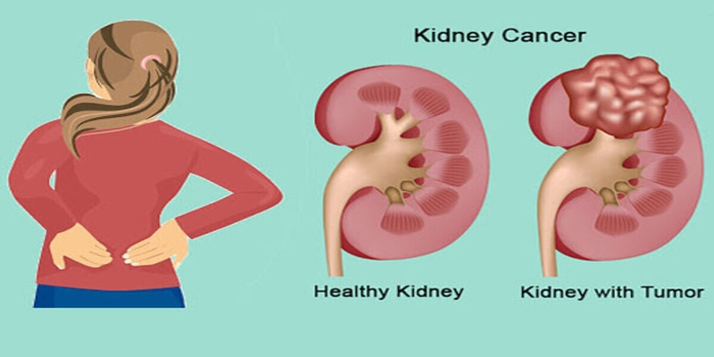 Để ý đến những triệu chứng bệnh u thận để thăm khám kịp thời tránh nguy hiểm