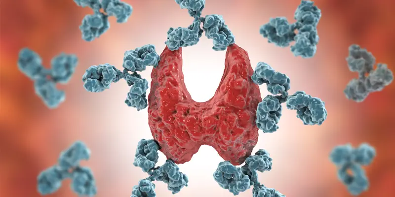 U tuyến giáp là tình trạng xuất hiện các khối u rắn trên tuyến giáp