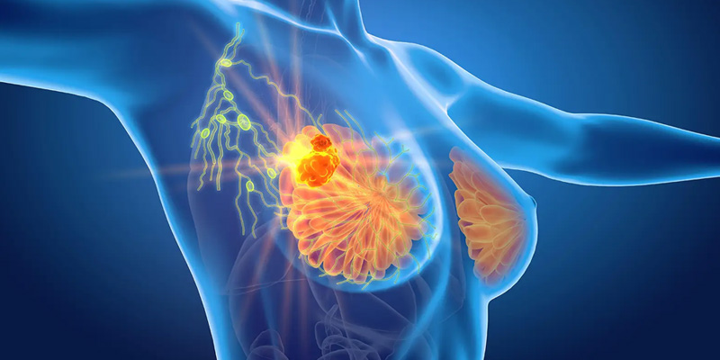 U vú Birads 4 có nguy cơ phát triển thành ung thư vú