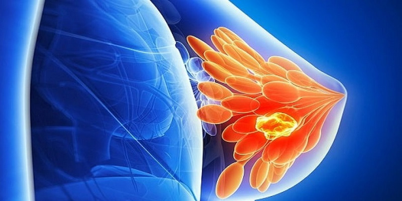 U xơ tuyến vú là bệnh lý phổ biến ở nữ giới