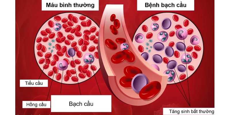 Ung thư bạch cầu là bệnh lý ung thư xuất phát từ tế bào bất thường trong tủy xương