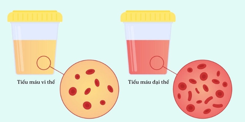 Tiểu máu là dấu hiệu đầu tiên để nhận biết ung thư bàng quang