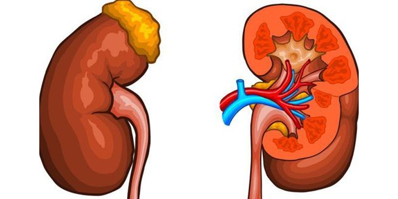 Ung thư biểu mô tế bào thận di căn
