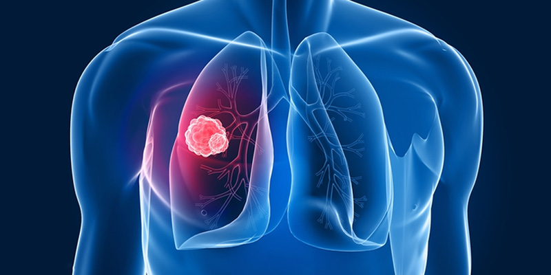 Tìm hiểu thông tin ung thư biểu mô tuyến