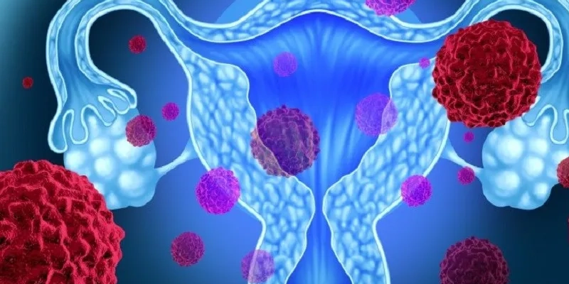 Virus HPV lây qua đường tình dục là nguyên nhân chính gây ung thư cổ tử cung