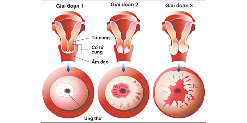 Nhiễm virus HPV là nguyên nhân gây bệnh ung thư cổ tử cung chủ yếu mà ai cũng có thể gặp phải
