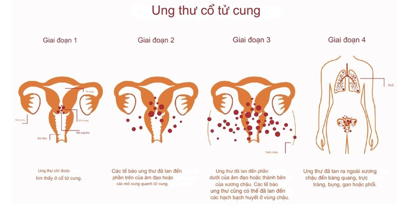 Phân giai đoạn ung thư cổ tử cung