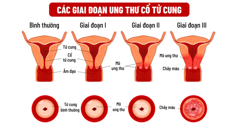 Các giai đoạn diễn tiến của ung thư cổ tử cung