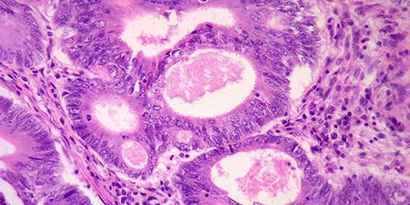 Carcinoma tế bào gai (SCC) do tiếp xúc lâu dài với tia cực tím