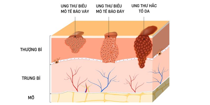 3 loại ung thư da phổ biến nhất gồm ung thư biểu mô tế bào vảy, ung thư biểu mô tế bào đáy và ung thư hắc tố da