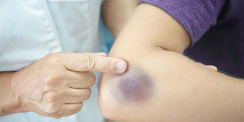 Đốm đỏ, tím trên da có thể cảnh báo tế bào ung thư máu đã bắt đầu phát triển