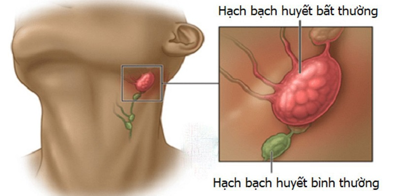 Ung thư hạch bạch huyết là sự phân chia mất kiểm soát của các tế bào bạch cầu Lympho