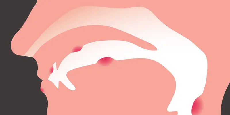 Ung thư khoang miệng có nguy hiểm không? Câu trả lời là có