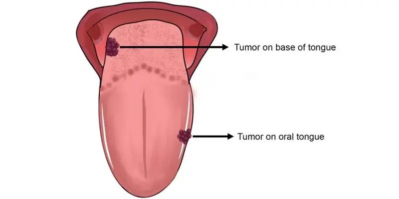 Ung thư lưỡi có hai phần chính