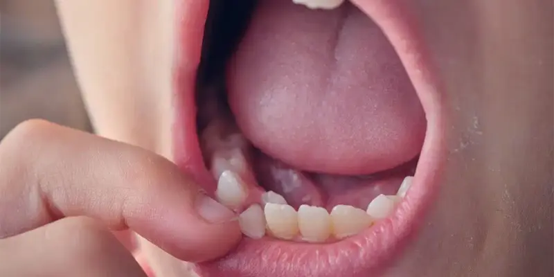 Ung thư lưỡi giai đoạn 2 nên chăm sóc và tuân thủ theo phác đồ điều trị