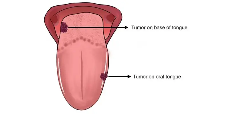 Ung thư lưỡi có hai phần gồm phần trước lưỡi và phần gốc lưỡi