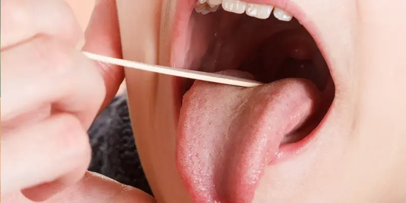 Ung thư lưỡi là một bệnh lý ác tính