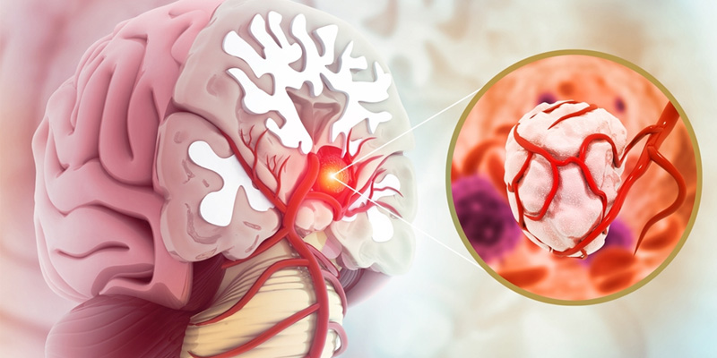 Ung thư não có hai nhóm gồm u não nguyên phát và u não di căn