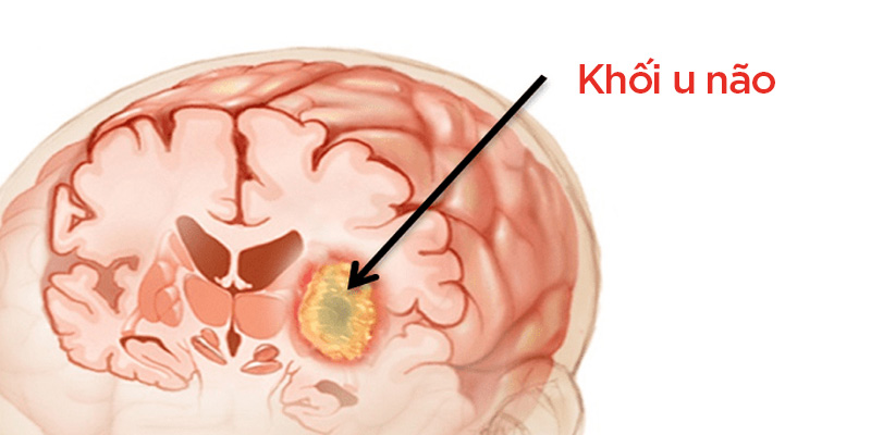 Ung thư não là gì