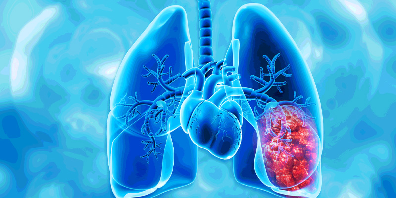 Ung thư phổi có chữa được không