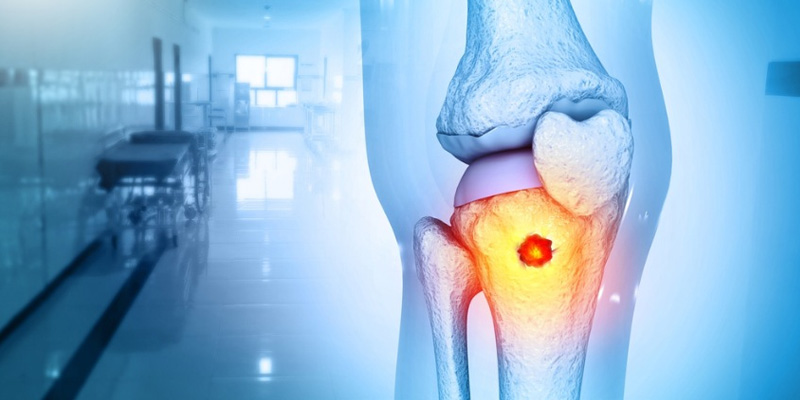 Ung thư phổi di căn xương là giai đoạn trễ, các phương pháp điều trị chủ yếu giúp kéo dài thời gian và tăng chất lượng sống của người bệnh.