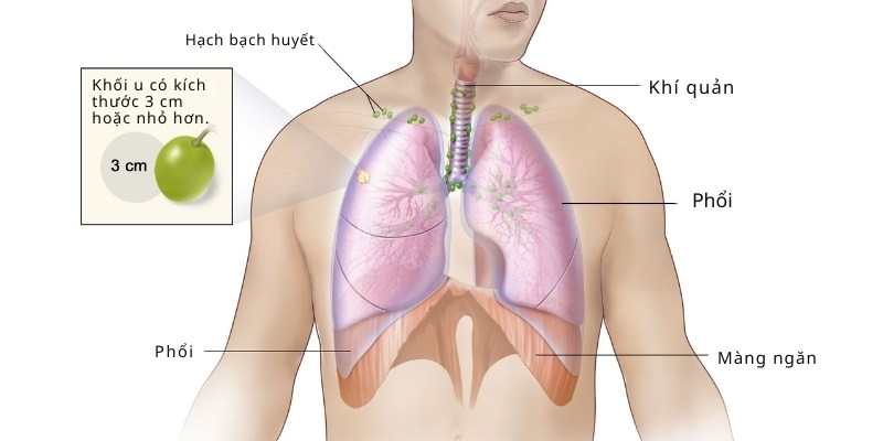 Ung thư phổi giai đoạn đầu 1A