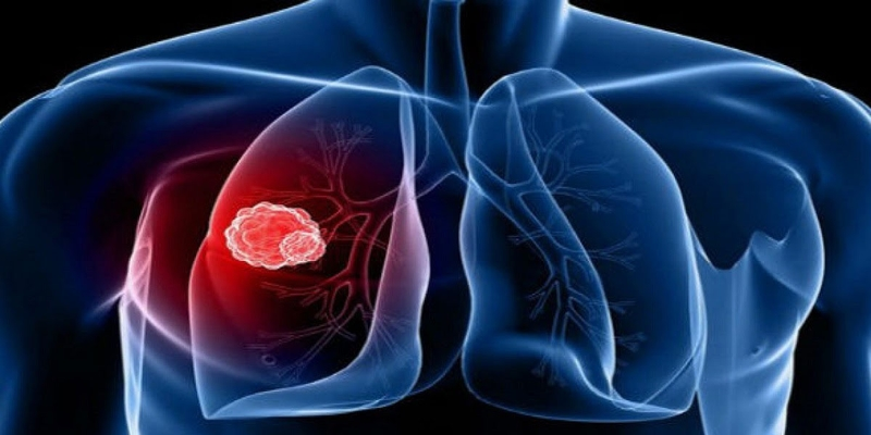 Chìa khóa để nâng cao hiệu quả điều trị ung thư phổi chính là phát hiện bệnh sớm