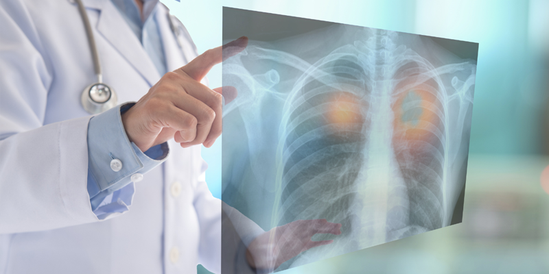 Ung thư phổi giai đoạn 2 có thể lan đến các hạch bạch huyết gần phổi, nhưng chưa có dấu hiệu di căn xa