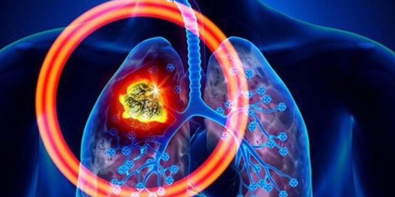 Khoảng 30% bệnh nhân khi phát hiện thì đã mắc ung thư phổi giai đoạn 2