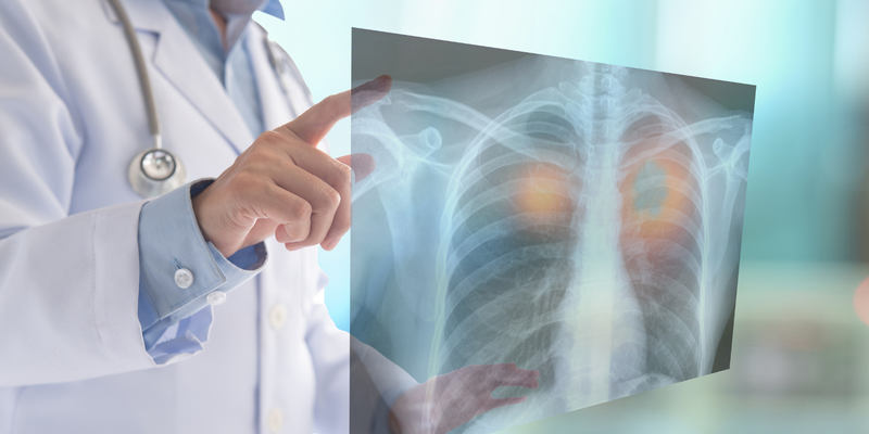 Ung thư phổi giai đoạn 3 có thể chữa được không