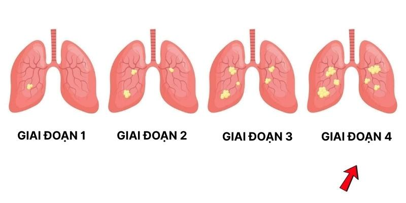 Ung thư phổi giai đoạn 4 là giai đoạn tế bào ung thư đã lan rộng