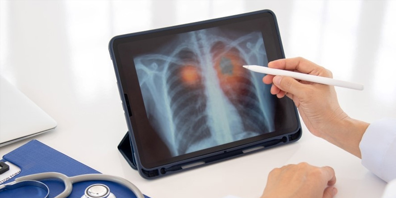 Ung thư phổi không tế bào nhỏ