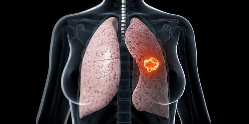 Ung thư phổi thứ phát có tỷ lệ tử vong cao