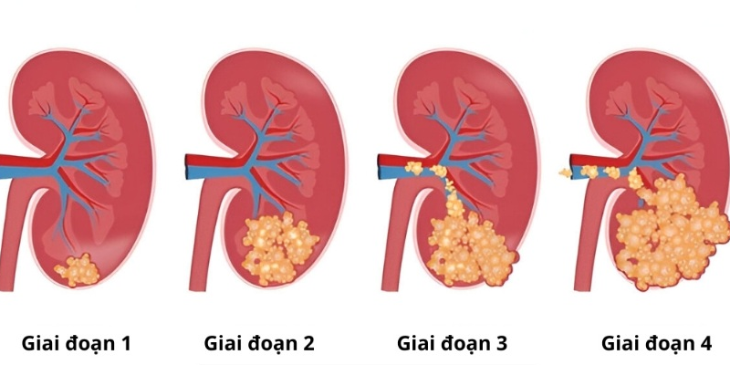 Các giai đoạn ung thư thận