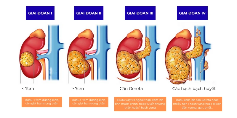 Tỷ lệ sống sau 5 năm theo từng giai đoạn của bệnh ung thư thận