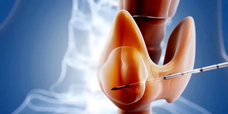 Ung thư tuyến giáp có thể di căn qua các hạch bạch huyết xung quanh