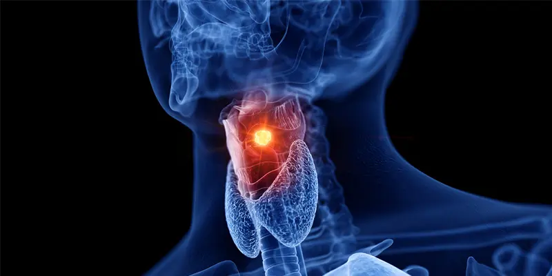 Ung thư vòm họng là bệnh thường gặp ở nam giới