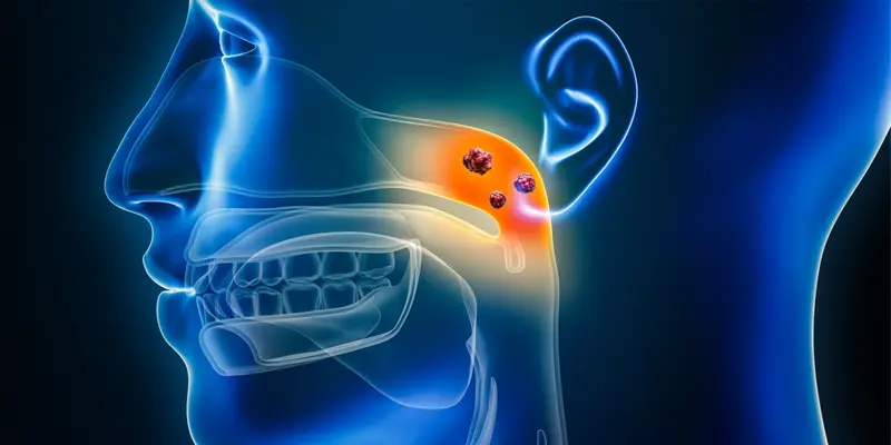 Ung thư vòm họng xảy ra ở vị trí khó phát hiện với nhiều triệu chứng dễ gây nhầm lẫn