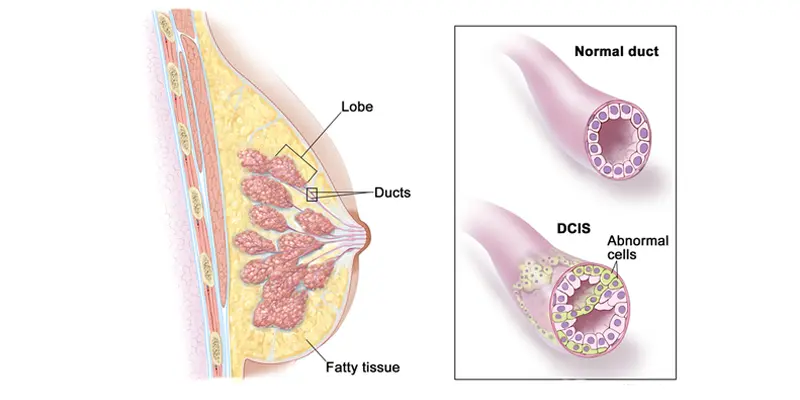 Ung thư vú dạng sàng tiên lượng sau điều trị tốt
