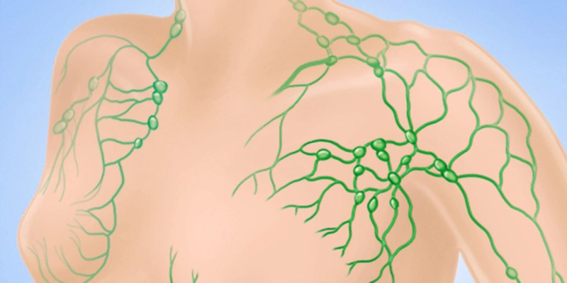  Ung thư vú di căn hạch bạch huyết