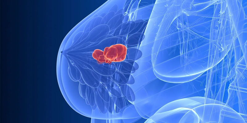 Ung thư vú di căn là cực kỳ nguy hiểm ở phụ nữ