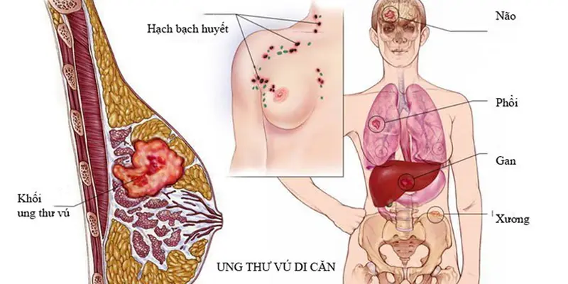 Ung thư vú di căn phổi