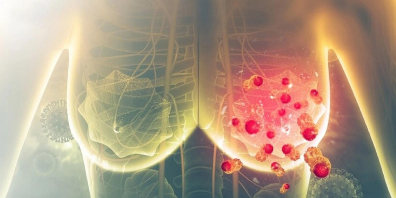 Ung thư vú giai đoạn 3 đã lan đến nhiều hạch bạch huyết gần vùng vú