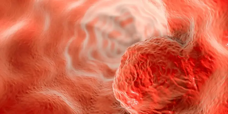 Nhiều bệnh nhân muốn biết ung thư vú giai đoạn 3 sống được bao lâu